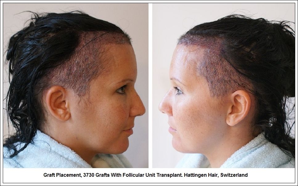 greffe de cheveux femme avis greffe de cheveux femme avis